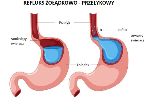Ilustracja pokazuje, co to refluks żołądkowo-przełykowy: cofanie się treści żołądkowej do przełyku z powodu otwartego zwieracza.