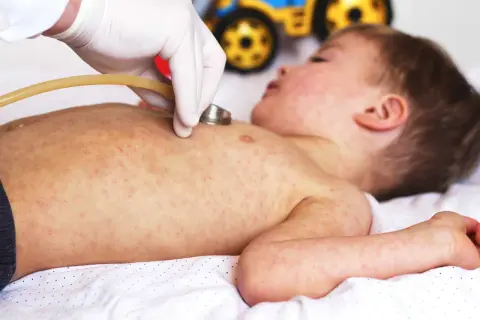 Läkare undersöker ett barn med utslag, möjligen biverkningar efter 5 månaders vaccin.