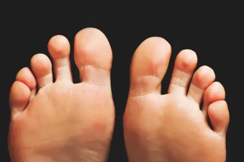 Piedi con alluce valgo, un problema comune per cui esistono diversi rimedi.