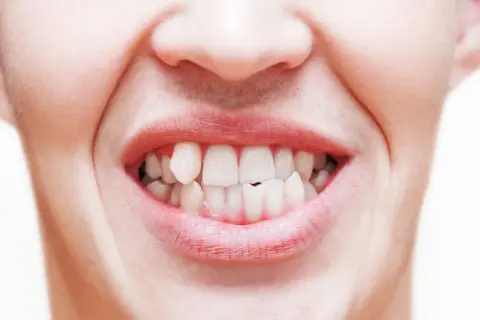 Primo piano di una bocca con labbra arrossate e denti bianchi, alcuni leggermente storti, che sembrano battere per il freddo o la tensione.