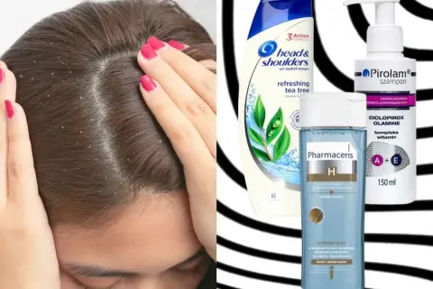 Łupież na głowie i szampony przeciwłupieżowe: Head & Shoulders, Pirolam, Pharmaceris. Co jest dobre na łupież?