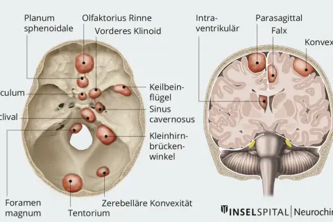 Anatomische Darstellung des Schädels mit roten Markierungen, die auf mögliche gutartige Tumoren im Kopf hindeuten. Symptome können je nach Lage variieren.