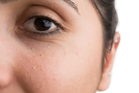 Nahaufnahme des Gesichts einer Frau mit kleinen, weißen Pickelchen, die als grain de milium bekannt sind, unter dem Auge.