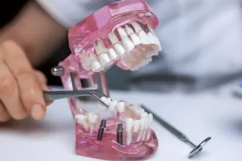 Model szczęki z implantami i mostem tymczasowym. Dowiedz się, jak długo można nosić most tymczasowy.