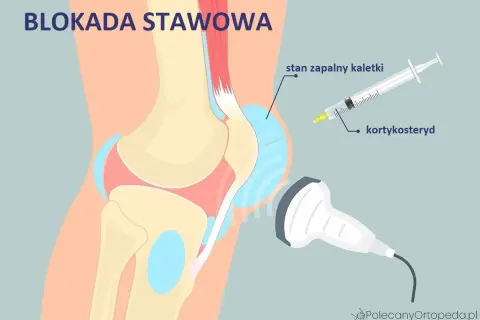 Zastrzyk z kortykosteroidu w stan zapalny kaletki stawu kolanowego, widoczne ścięgna w kolanie.