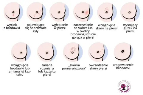 Jak rozpoznać raka piersi: wyciek z brodawki, wgłębienie, zaczerwienienie, guzek, zmiana kształtu piersi, "skórka pomarańczowa".