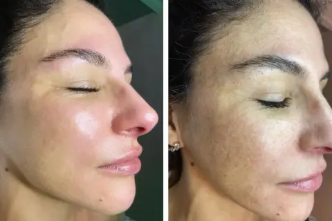 Viso prima e dopo acido mandelico: pelle più luminosa e uniforme, macchie attenuate.