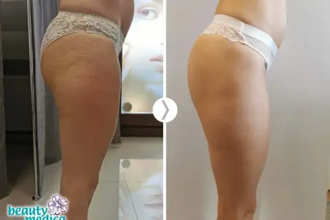 Endermologia: Co ile zabiegów? Twój plan na trwałe efekty!