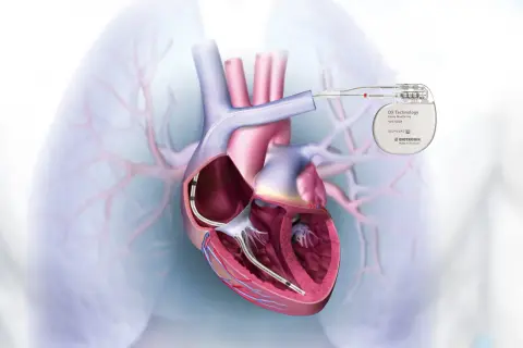 Cœur humain avec un défibrillateur cardiaque implanté, relié à un appareil externe.