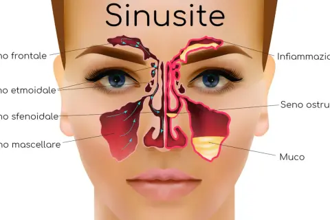 Illustrazione anatomica della sinusite, con enfasi sulla sinusopatia mascellare, mostrando infiammazione e accumulo di muco nei seni paranasali.