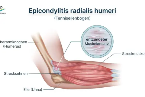 Illustration zeigt den Tennisellenbogen (Epicondylitis radialis humeri) mit entzündetem Muskelansatz. Darf man mit Tennisarm arbeiten? Ja, oft mit Anpassungen.