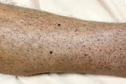 Hud med många små lila prickar, som kan vara symtom på leukemi hos barn.