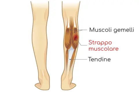 Dettaglio anatomico del polpaccio con strappo muscolare cicatrizzato male nei muscoli gemelli.
