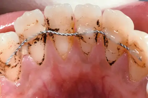Denti con placca e filo metallico per contenzione denti.