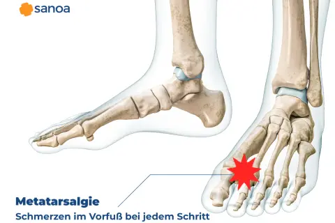 Metatarsalgie: Schmerzen im Vorfuß bei jedem Schritt. Anatomische Darstellung des Fußskeletts mit Hervorhebung des schmerzenden Bereichs.
