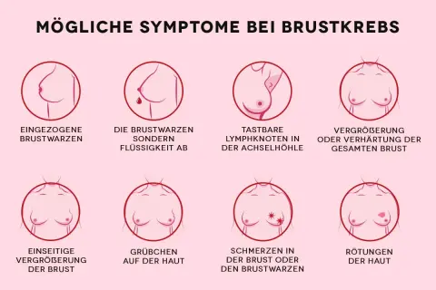 Grafik zeigt mögliche Symptome von Brustkrebs, darunter tastbare Lymphknoten in der Achselhöhle und eine Vergrößerung oder Verhärtung der Brust.