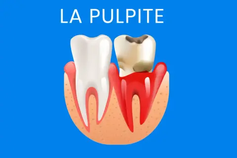 Dente sano a sinistra, dente cariato e infiammato a destra, con la scritta "LA PULPITE" in alto.