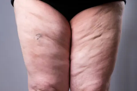 Widoczne uda z widocznymi nierównościami skóry, charakterystycznymi dla lipodemu. Widoczne drobne naczynka.