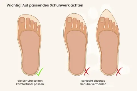 Passende Schuhe sind wichtig, um Druckstellen am Zeh zu vermeiden. Links ein Fuß im gut sitzenden Schuh, rechts Füße in zu engen Schuhen.