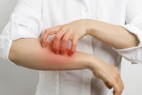 Une personne se gratte le bras, la peau rougie et irritée, possiblement à cause d'une allergie au calcaire.