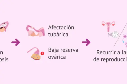 Ilustración muestra cómo la endometriosis puede afectar las trompas y ovarios, llevando a la necesidad de técnicas de reproducción asistida para el embarazo.