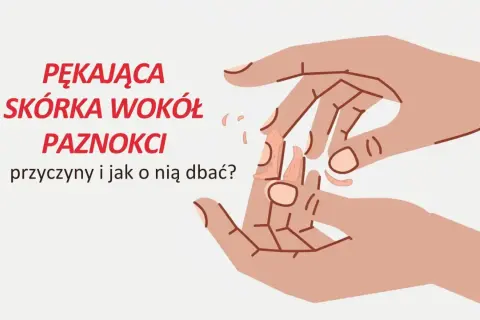 Pękająca skórka wokół paznokci. Ilustracja dłoni z suchymi, łuszczącymi się skórkami przy paznokciach.