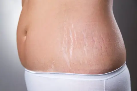 Bauch einer Frau mit Dehnungsstreifen, ein Zeichen der zweiten Schwangerschaft.