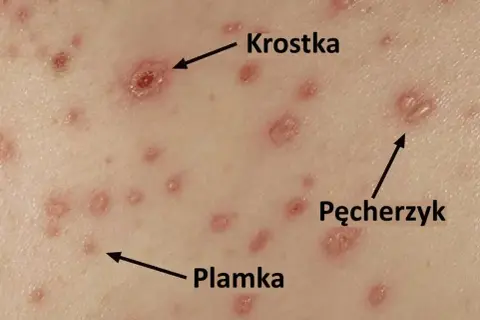 Skóra z licznymi zmianami: plamkami, krostkami i pęcherzykami. To po dniu ospa początki.