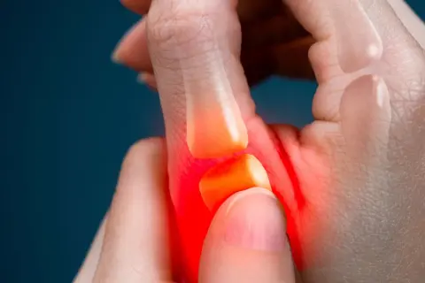 Main d'une personne souffrant de tendinite au pouce, avec une zone rouge indiquant la douleur. Le traitement de la tendinite du pouce est essentiel.
