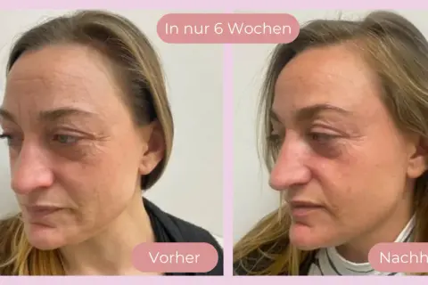 Vorher-Nachher-Vergleich: Hautbild einer Frau vor und nach 6 Wochen Behandlung. Deutliche Reduzierung von Falten, die Haut wirkt straffer. Kollagen-Effekt sichtbar.