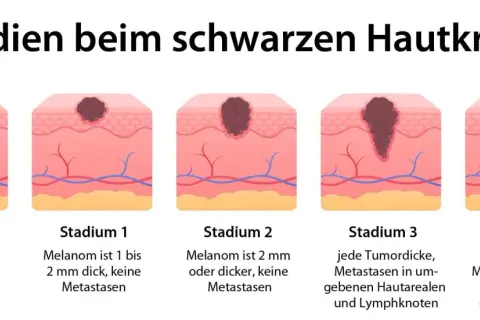 Illustration zeigt Stadien von schwarzem Hautkrebs. Symptome reichen von frühen Tumoren in der Oberhaut bis zu Metastasen in entfernten Körperregionen.