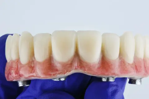 Proteza zębowa na implantach, wykonana w ramach NFZ. Sztuczne zęby z różową podstawą, trzymane w niebieskiej rękawiczce.