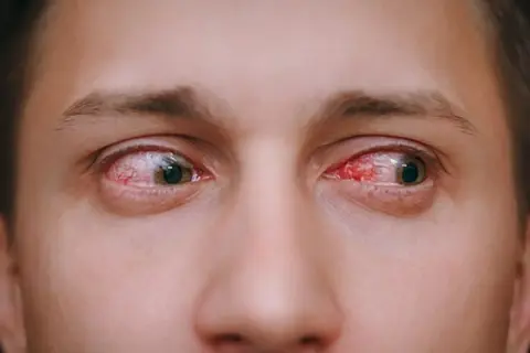 Ojos rojos e irritados, señal de que la conjuntivitis es contagiosa.