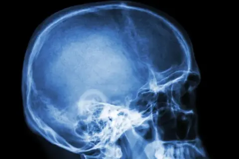 Rentgen czaszki z profilu. Widoczne struktury kostne głowy, w tym jama czaszki, kości twarzy i szczęka. Może to być pomocne w diagnostyce schorzeń wpływających na nerw błędny.