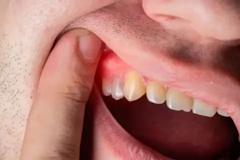Co wyciąga ropę z zęba? Tylko dentysta! Ulga i ratunek