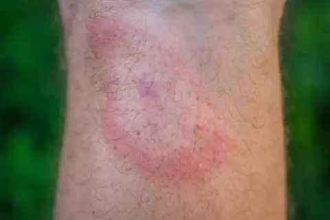 Rote, juckende Stelle am Bein nach einem Zeckenbiss. Wann zum Arzt? Informieren Sie sich über Symptome und Behandlung.