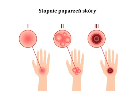 Ilustracja pokazuje stopnie poparzeń skóry: I stopień to zaczerwienienie, II stopień to bąble po oparzeniu słonecznym, a III stopień to głębokie uszkodzenie.