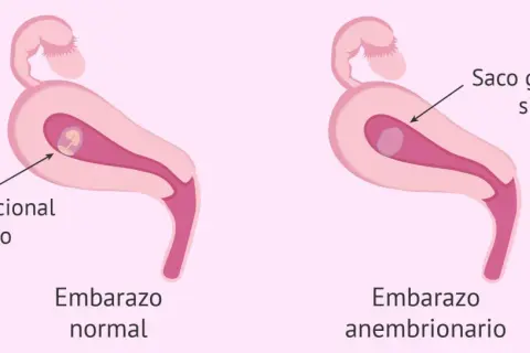 Ilustración comparativa de un embarazo normal con saco gestacional y feto, y un embarazo anembrionario con saco gestacional sin feto. Experiencias de embarazo anembrionario.
