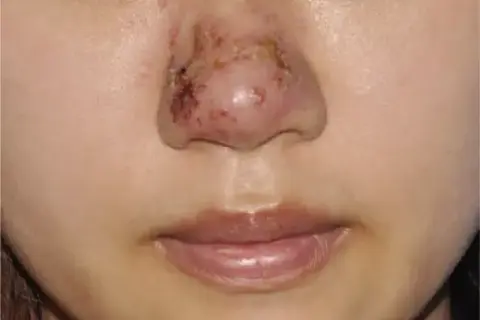 Biofilm po kwasie hialuronowym objawy: jak uniknąć powikłań?