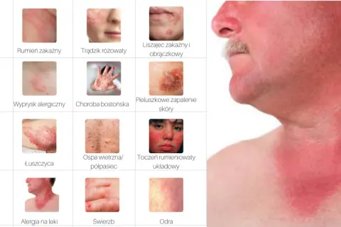 Jak wygląda alergia skórna zdjęcia – poznaj objawy i ich wygląd