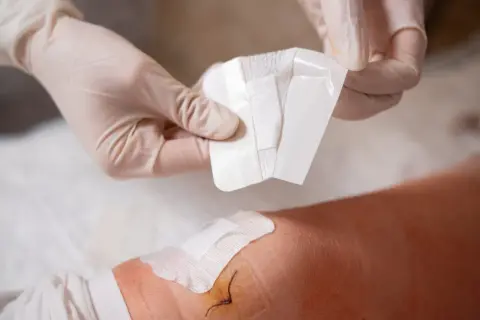 Rękawiczki medyczne przygotowują nowy plaster, by zmienić ten, który wywołał uczulenie od plastra opatrunkowego.