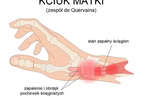 Ilustracja anatomiczna dłoni z zaznaczonym zapaleniem pochewek ścięgnistych kciuka.