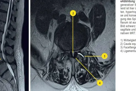 MRT-Aufnahmen der Lendenwirbelsäule zeigen eine Spondylolisthese L4/5, die auf Osteochondrose LWS hindeutet. Verdicktes Ligamentum flavum verengt den Spinalkanal.