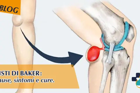 Illustrazione anatomica del ginocchio che mostra una cisti di Baker. Scopri come sfiammare cisti di Baker, cause, sintomi e cure.