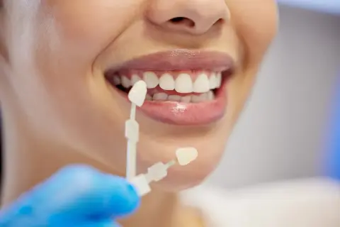 Dobór koloru licówek do naturalnych zębów. Na ile zębów zakłada się licówki? Decyzja należy do pacjenta i dentysty.