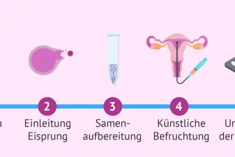 Der Insemination Ablauf: Stimulation der Eierstöcke, Eisprung-Einleitung, Samenvorbereitung, künstliche Befruchtung, Lutealphase-Unterstützung.