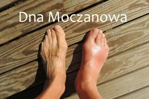 Dwa stopy na drewnianym tarasie. Prawy stopa jest zaczerwieniona i opuchnięta, co sugeruje podagrę.