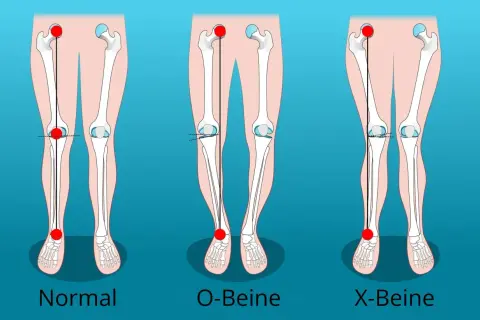 Vergleich von normalen Beinen, O-Beinen und X-Beinen. Die Darstellung zeigt die Knochenstruktur und die Ausrichtung der Gliedmaßen.