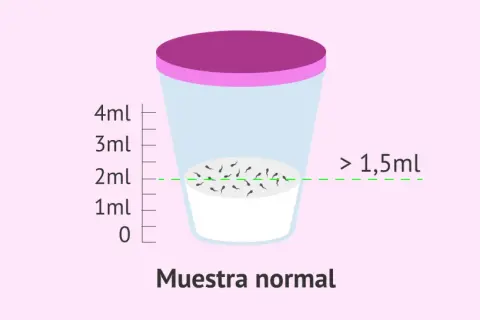 Recipiente con muestra de semen, indicando que la cantidad normal de espermatozoides en una eyaculación es mayor a 1,5ml.
