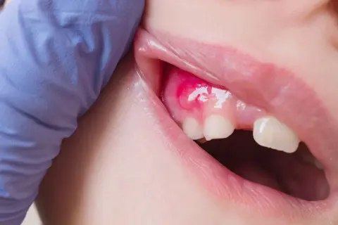 Boca con encía inflamada y un bulto de pus. Un guante azul sujeta la mejilla.